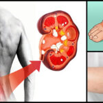 Signs Of Kidney Disease