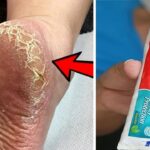 Get Rid Of Cracked Heels Permanently In 3 Days With Toothpaste