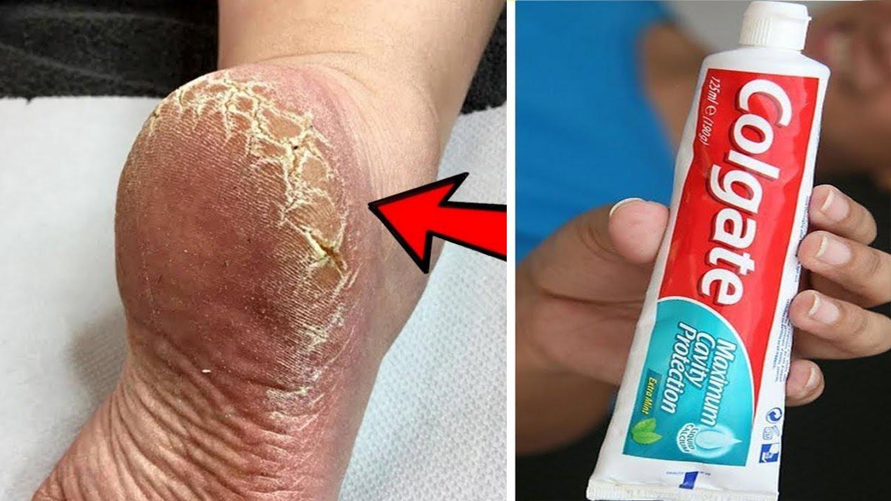 Get Rid Of Cracked Heels Permanently In 3 Days With Toothpaste